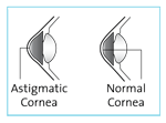 Astigmatism Normal cornea vs astigmatic cornea
