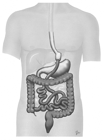 gastric-bypass Laparosocpic gastric bypass surgery at the Bariatric Surgery Center