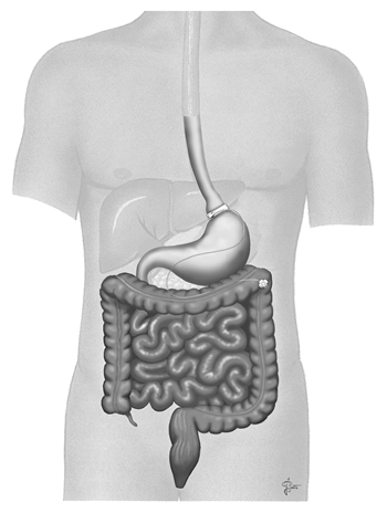 lap-band Bariatric lap-band surgery
