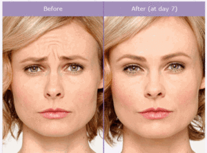 Botox-BeforeAndAfter Botox Before and After